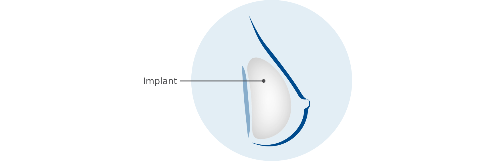 Reconstruction mammaire en une étape